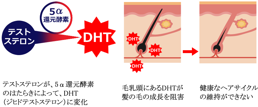 AGAの発症と進行